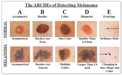 ABCD skin test